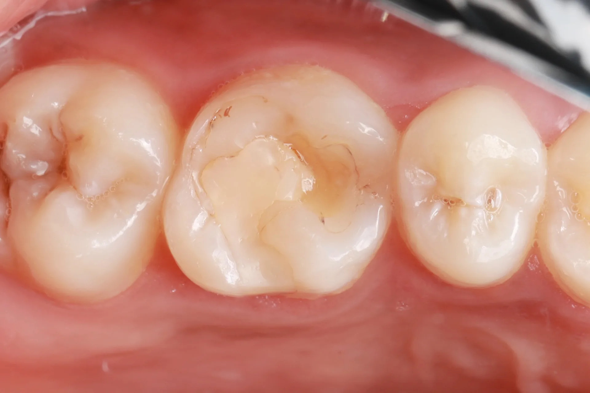 Composite Filling — Tooth 14 before