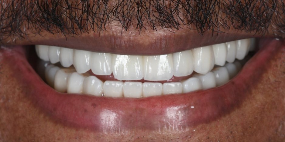 After treatment