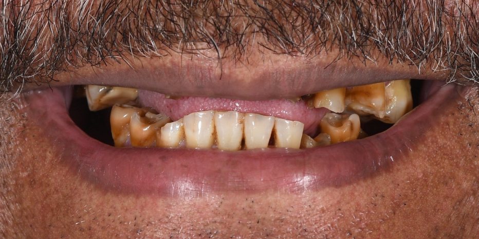 Before treatment