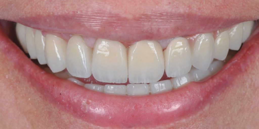 After treatment