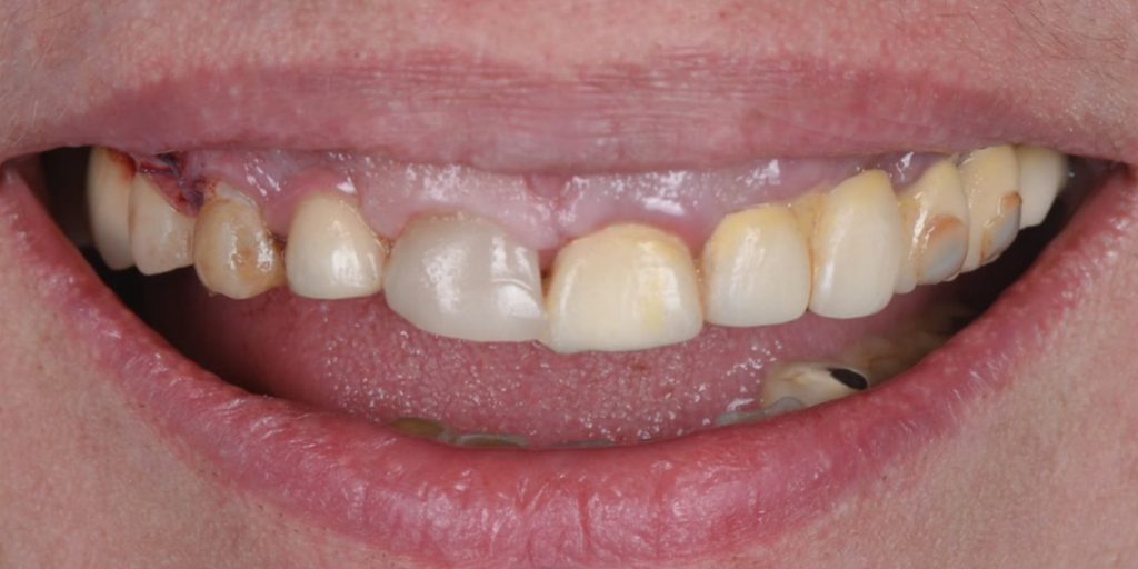 Before treatment
