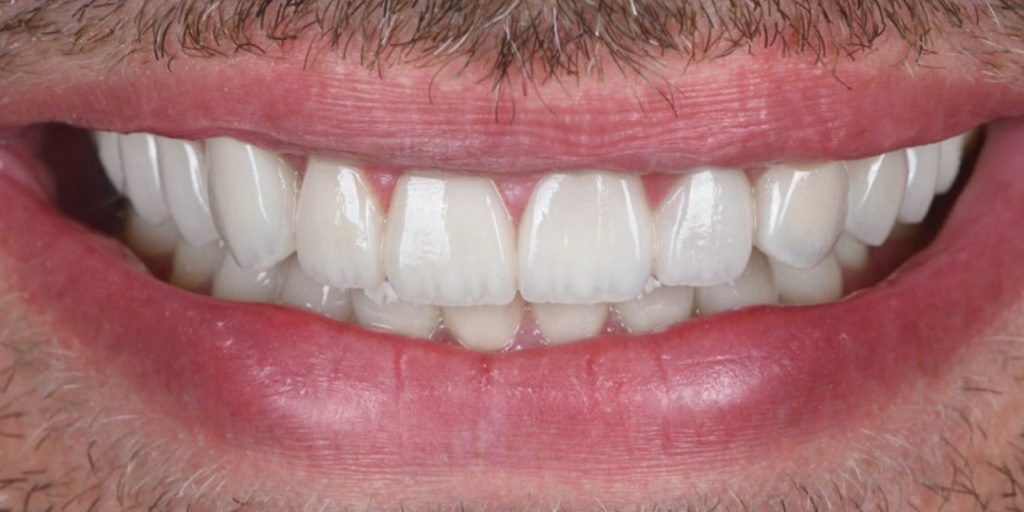 After treatment