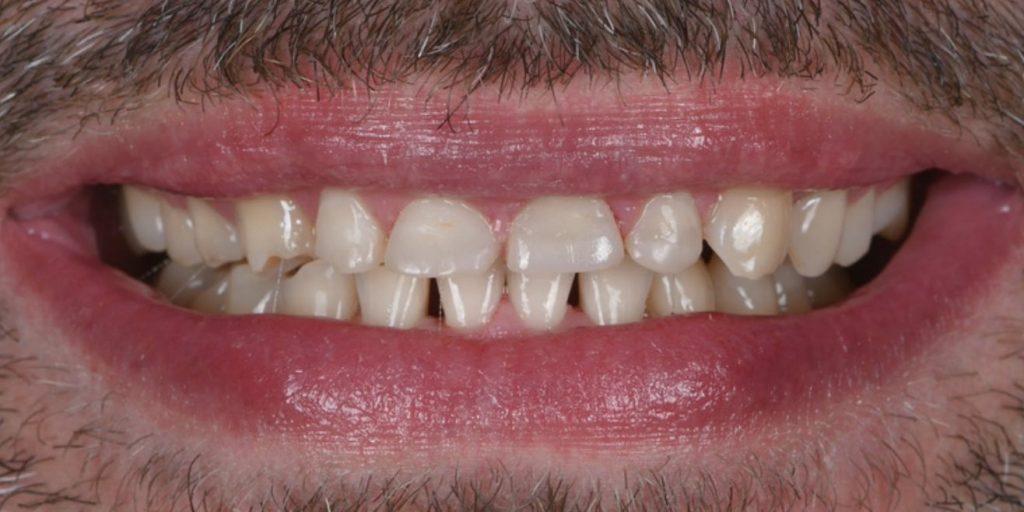 Before treatment